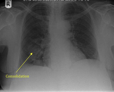 Chest X-ray illustrating right basal consolidation ...