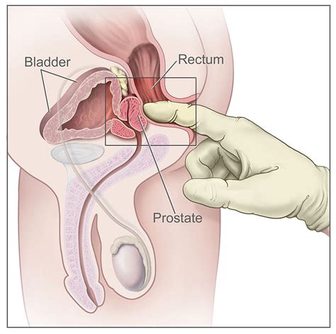 ✔ common therapeutic prostate massage effects: Daily orgasms can greatly reduce risk of prostate cancer ...