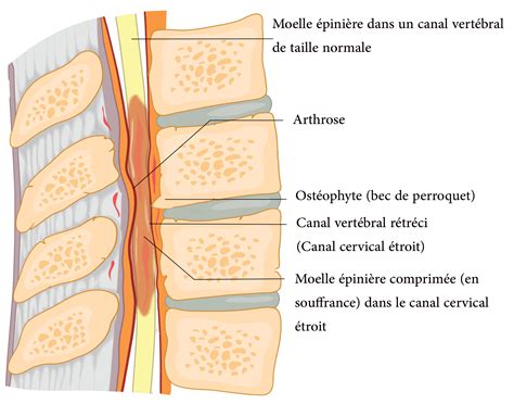 Cette pathologie se manifeste par des difficultés à marcher et/ou des douleurs importantes. Le canal lombaire étroit et la sténose foraminale - Dr ...