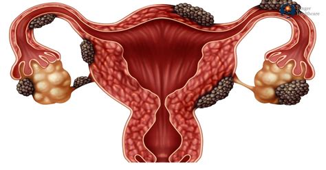 Endometriosis is a full body condition in which cells similar to those in the endometrium, the layer of tissue that normally covers the inside of the uterus, grow outside the uterus. Endometriosis: Causes, Symptoms, Diagnosis & Treatment options