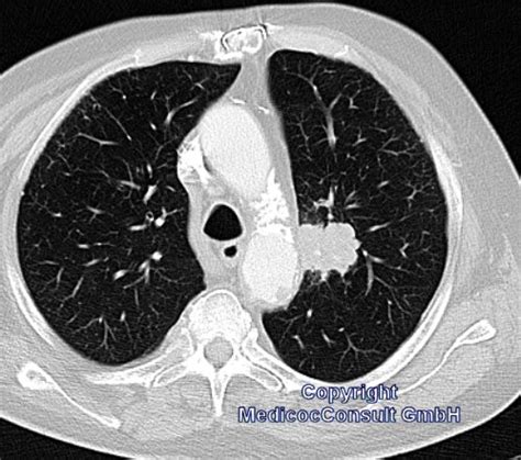 Es finden sich noch restnarben im bereich der. Lungenkarzinom - Falldarstellung