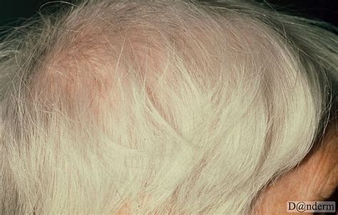 A female aged 64 reported sudden whitening of the hair. 4-18-5 White hair overnight