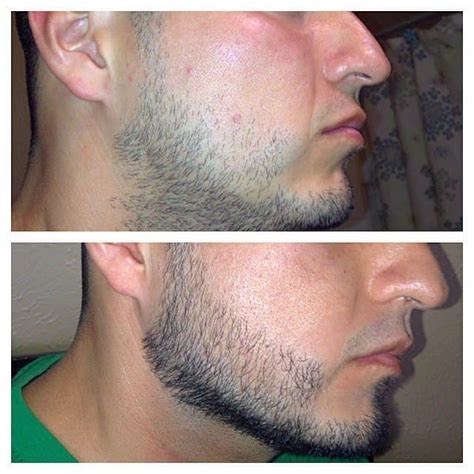 2% vs 5% minoxidil for beard. Everything You Need to Know About Rogaine (Minoxidil) on ...