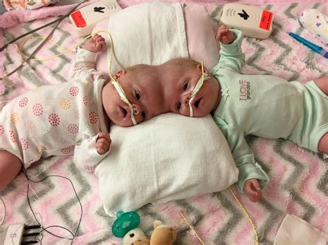 $36,150 raised of $100,000 goal. Twins who survived one of the rarest separation surgeries ...