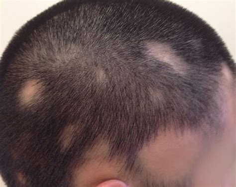 But it can be treated and hair can grow back. Alopecia Treatment | Hairmedic