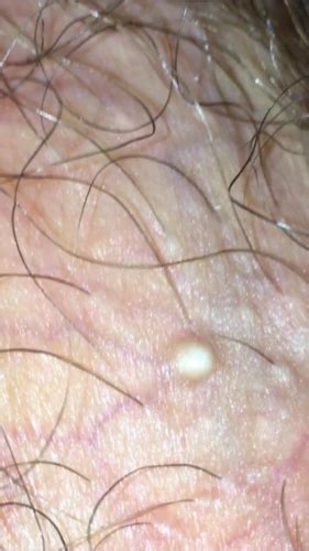 When the hair is not properly shaved on fragile skin, it can curl inside it, forming a bump, and can progress to pseudofolliculitis or even folliculitis. What is this on my testicles?! | Sexual Health | Forums ...