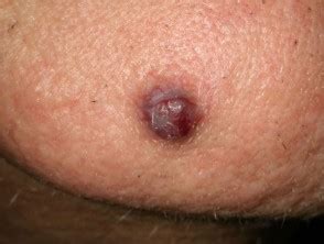 They often disappear when you apply pressure efficacy and safety of cryotherapy vs. Cherry angioma | DermNet NZ