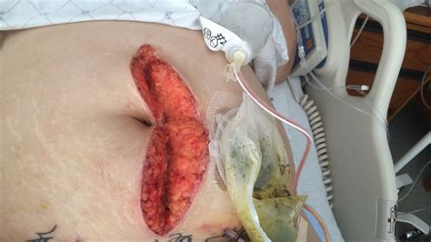 Your comment must be in english or it will be removed. Sterile Wet-to-Dry Dressing Change after KCI Wound Vac ...