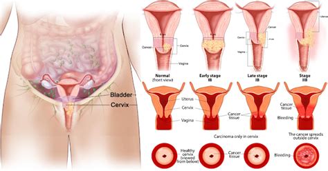 If you experience any of the following symptoms, it may be a sign of advanced cervical cancer: Cervical Cancer - Causes, Symptoms, Stages & Prevention