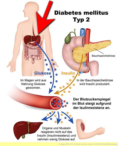 Hinweise zur verabreichung von acarbose: Fettsucht Diabetes mellitus: wie zu hohes Gewicht krank ...