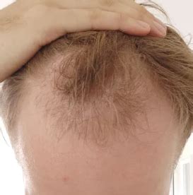 Here are our professional recommendations. 3 months minoxidil, finasteride and microneedling ...