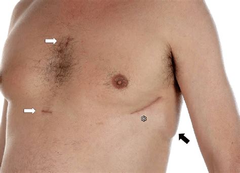 Aicds are common cardiac devices designed for both patient monitoring and therapy in case of ventricular tachycardia or fibrillation. Novel position of the entirely subcutaneous implantable ...