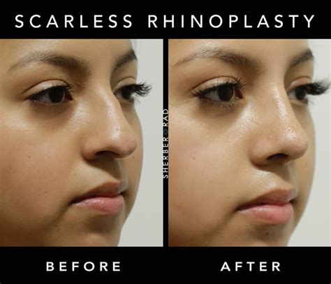 Since filler does not last long, rhinoplasty is the solution for permanent result! Rhinoplasty Washington DC | Nose Job Northern VA