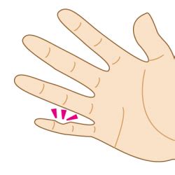 スマホの持ち方で変形した小指【テキストサム損傷 ...
