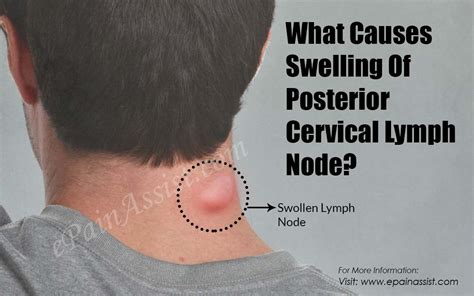 Clinically, surface anatomy is used to split the neck into anterior and posterior triangles which provide clues as to the location of specific structures. Swollen Posterior Cervical Lymph Nodes In Neck - slideshare