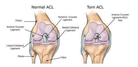 Acl accurately identifies and controls packets on the network to manage network access behaviors, prevent network attacks, and improve bandwidth use efficiency. ACL Reconstruction Review - Iron Health Physical Therapy ...
