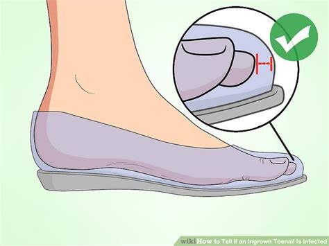 In many cases, skin infections like staph, strep, or mrsa get started from the tiniest of cuts. 3 Ways to Tell if an Ingrown Toenail Is Infected - wikiHow