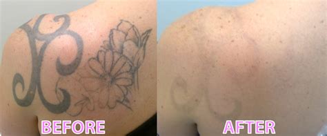 The healing process for a tattoo can last between two to four weeks. Laser Tattoo Removal - What you should be looking for ...