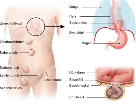 Wie bei erwachsenen tritt ein leistenbruch bei kindern meistens rechts auf. Hernien - gesundheitsinformation.de