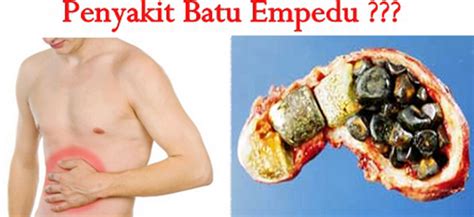 Check spelling or type a new query. MADU HITAM BATU EMPEDU