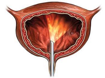 Está indicada como opção de planejamento familiar quando a família já se encontra constituída e não existe o mínimo desejo de ter mais filhos. UretroCistoscopía :: UroCare I Urólogos en Puebla