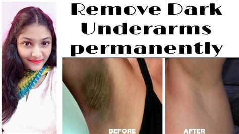 We did the research for you. ||Remove Dark underarms||permanently|| - YouTube