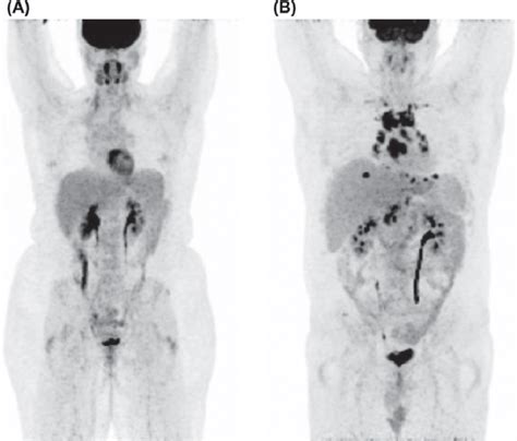 Ct scans are also referred to as computerized axial. Representative interim FDG-PET scans (maximum intensity ...