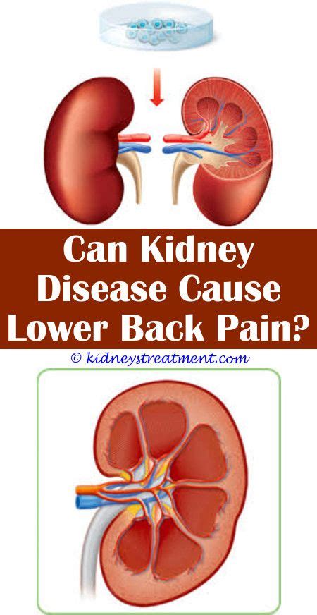 Insulin is a hormone that regulates blood sugar. Are Kidney Stones A Complication Of Diabetes - kidneyoi