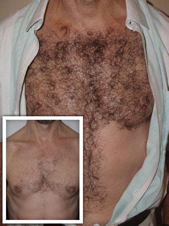 My closest partner didn't shave legs, armpits, pubic hair, nothing and it is okay. Body Hair Transplant | Miami, FL