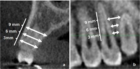 The incisors of neanderthals often have large labiolingual dimensions. Measurement based on the cross-sectional cone-beam ...