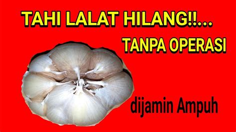 Apakah bisa tahi lalat dihapus? Cara Menghilangkan Tahi Lalat Alami Dengan Bawang Putih ...