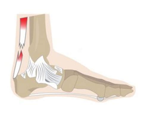 Wenn sie sich mit auch frühere probleme mit der achillessehne machen einen achillessehnenriss wahrscheinlicher. Achillessehnenriss, Achillessehnenruptur | CityPraxen Berlin