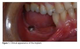 I fully realize that full or partial dentures are artificial, constructed of plastic, metal and/or porcelain. Implant-supported removable partial denture