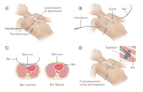 Surgery helps correct the deformity. What is pectus excavatum?