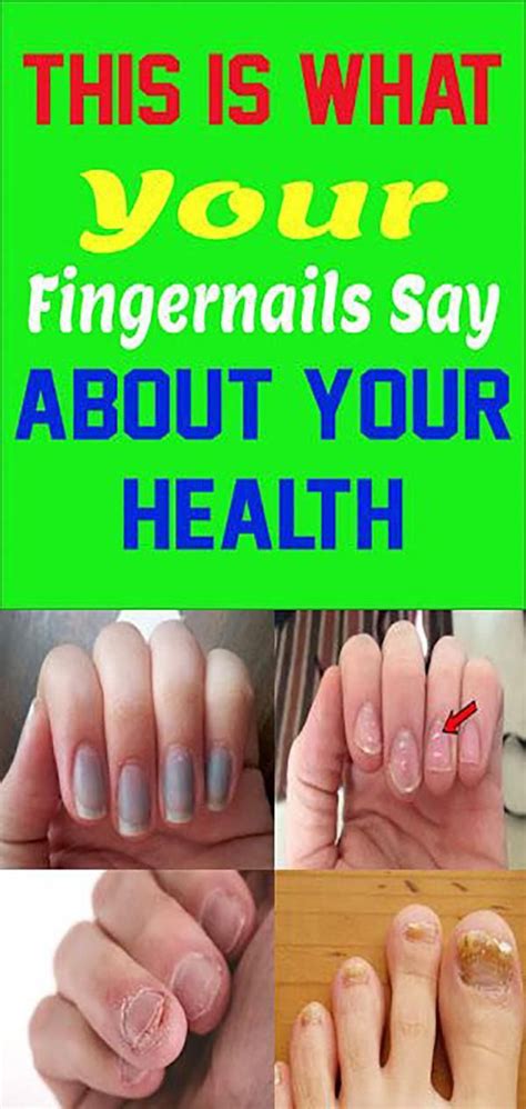 'white spots on nails can be caused by a deficiency in certain minerals and/or vitamins. This Is What Your Fingernails Say About Your Health ...