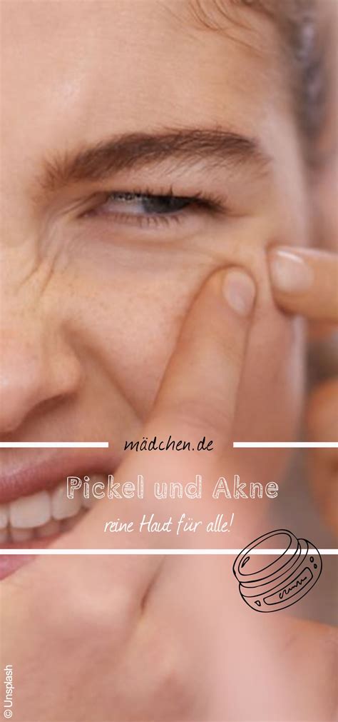 Manchmal auch noch für erwachsene ^^. Was tun bei Pickeln? | Akne, Anti pickel, Pickel