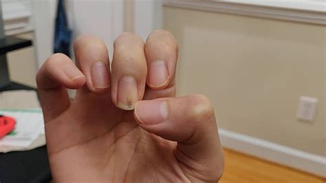 Should i cut it back? Nail Bed Damage Healing - YouTube