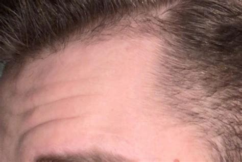 See the studies, photos, and answers. Am I balding (photos) | WRassman,M.D. BaldingBlog