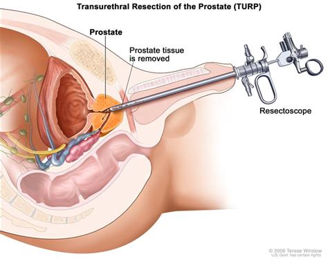 Prostatitis does not always involve the prostate. Prostate Cancer Treatment (PDQ®)-Patient Version ...
