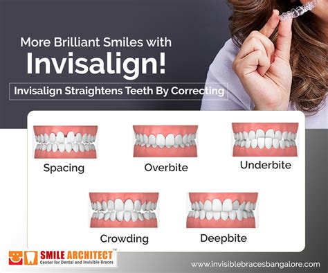 In most cases, invisible braces like invisalign cost more than the traditional metal 'train track' alternative. Invisalign-Invisible Alignment For A Confident Smile ...