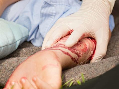 How to Treat Lacerations in the Field
