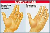 Dupuytren's contracture (also called dupuytren's disease, morbus dupuytren, viking disease, and celtic hand) is a condition in which one or more fingers become permanently bent in a flexed position. CRITICA EN LINEA-EPASA: Sección Variedades