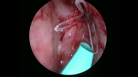 Symptoms include trouble breathing through the nose, loss of smell, decreased taste. Managing Recurrent Nasal Polyps - YouTube