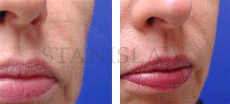 Laser treatment will usually remove unwanted tattoos completely, although it will take several treatments. Sculptra Gallery 2 Before and After Photos Connecticut