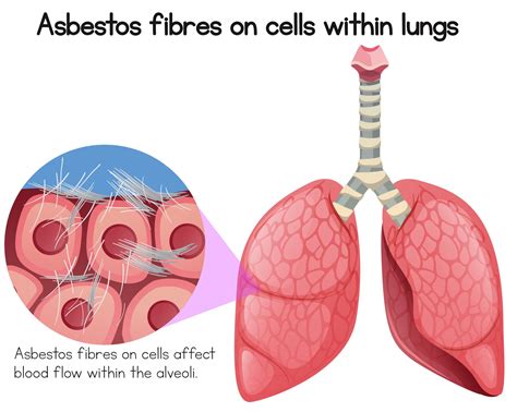 That said, it is crucial that your lawyer is attorney at law magazine is a national trade publication for and about private practice attorneys. What Is Mesothelioma and Asbestos Lung Cancer Lawsuit?