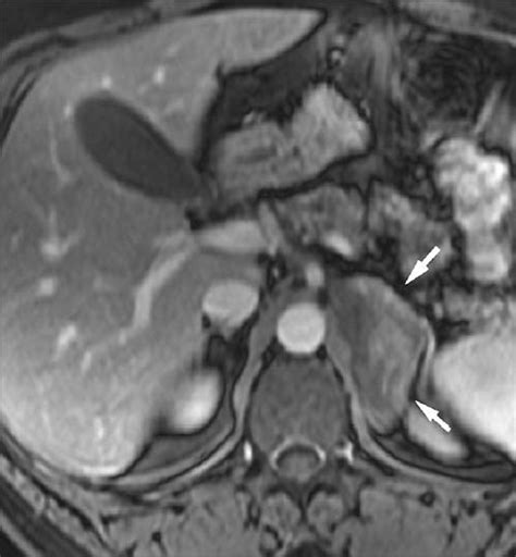 Unenhanced computed tomography and chemical shift magnetic resonance imaging can characterize. Adrenal Lesions: Spectrum of Imaging Findings with ...