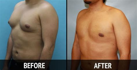 Fosamax may lower the calcium levels in your blood. Pin on Non Surgical Gynecomastia Treatment