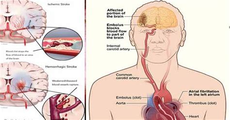 Nah, selanjutnya yang dapat anda jadikan cara untuk dapat menyembuhkan diri dari kondisi stroke ringan adalah dengan melakukan fisioterapi. Obat Stroke Ringan Tradisional: Obat Stroke Ringan