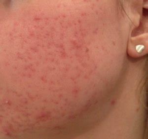 Pityriasis versicolor, or tinea versicolor, is a harmless disease defined by adjustments in the regular pigmentation of the skin, which resemble spots of blemished skin. Acne in je gezicht binnen 3 tot 6 maanden vrij van acne