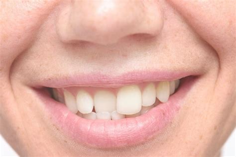 How to fix a crooked smiley piercing. Why You Need to Fix Crooked Teeth | Dentist in Columbia, MD